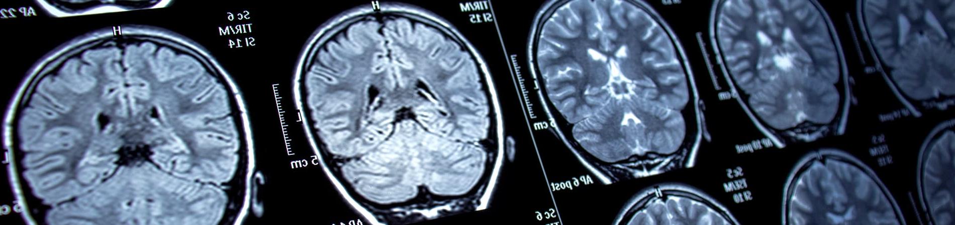 脑核磁共振扫描癫痫 & 癫痫发作